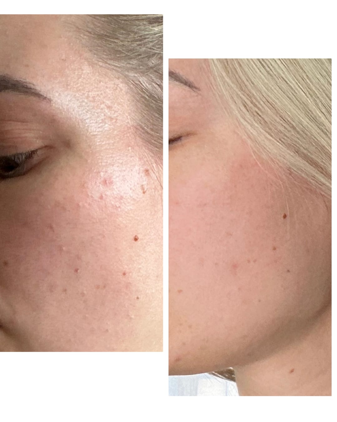 Customer photo review of Porenfeines 4% BHA PEELING