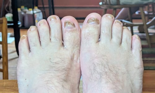 Customer photo review of Pentachom SE Antifungal Laser Program