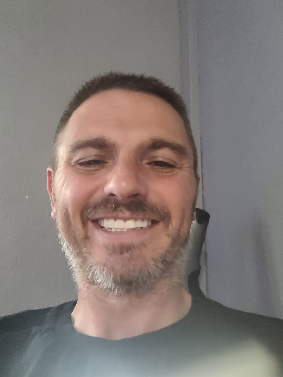 Customer photo review of Click-in Veneers 4.0