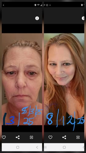 Customer photo review of Zoyava Soothe and Smooth Bundle: Cortisol 60 and Myo-Inositol 90 Capsules Supplement Bundle