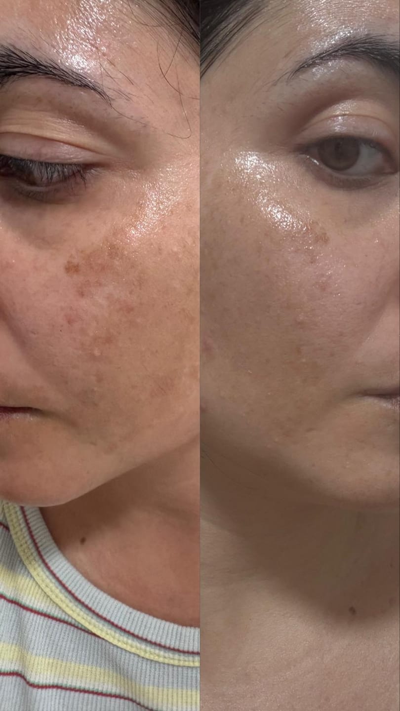 Customer photo review of RUTINA AM&PM - GRANITOS + MARCAS + POROS + MANCHAS + ARRUGAS