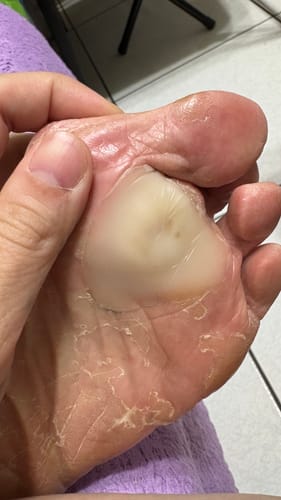 Customer photo review of BAND-AID OK繃 保護腳底雞眼、魚眼  4片