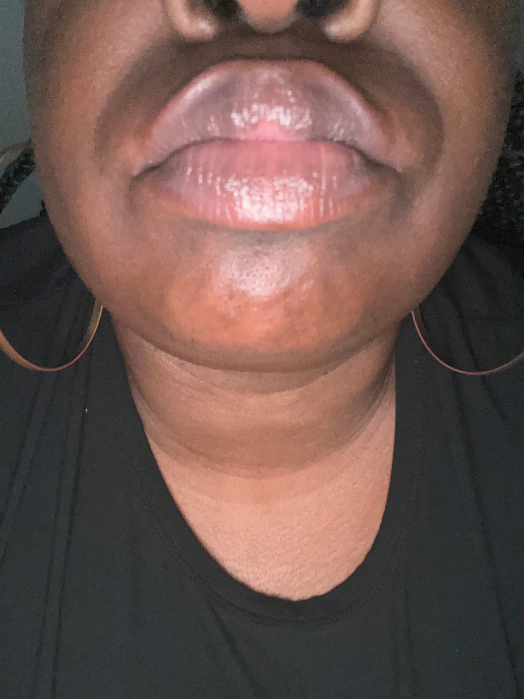 Customer photo review of Lips Lightening Cream For Men and Women (Results in 5 Days or Less)