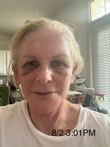 Customer photo review of Facial Surgery Recovery Bundle