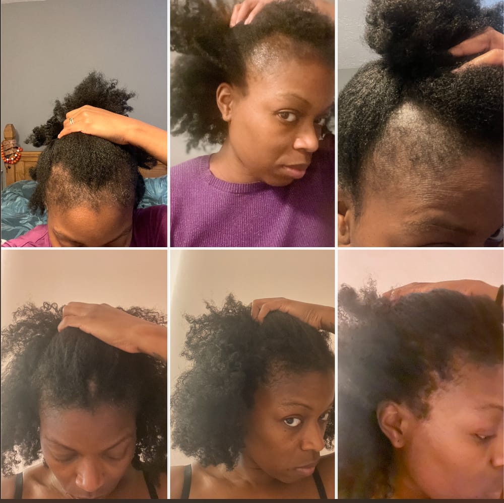 Customer photo review of Follicle Fuel Pro+ – Hair Growth Potion (Extra Strength)