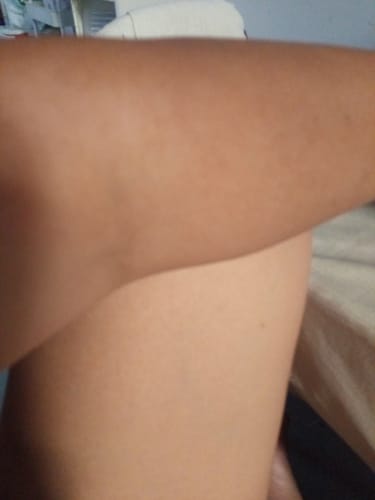 Customer photo review of Bad Skin™ Korean Collagen Bomb Hydrating Ampoule