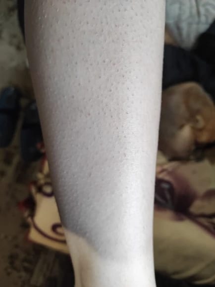 Customer photo review of SkinCare- Epilator sa kristalima