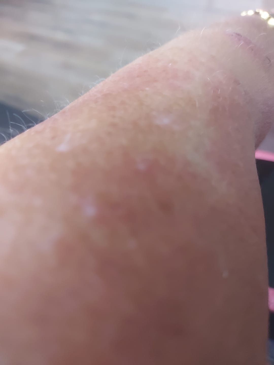 Customer photo review of Bioskin Zeoderm Skin Repair Moisturiser