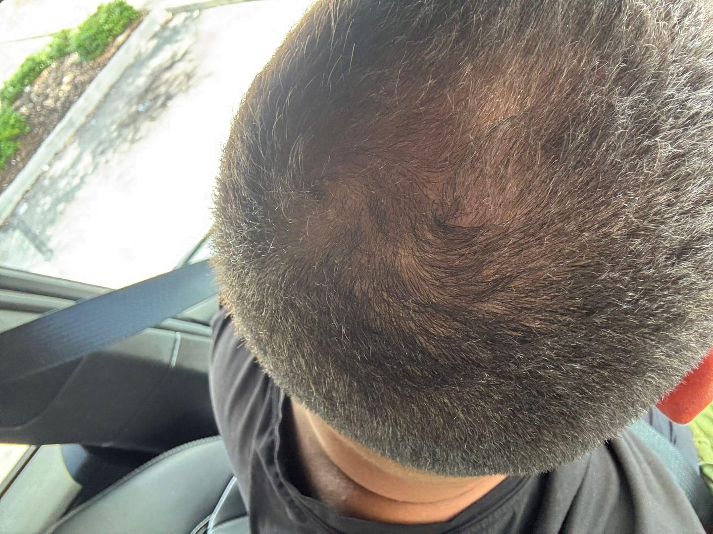 Customer photo review of Oleuma™ TrichoGenesis Complex – Advanced Hair Revival Oil