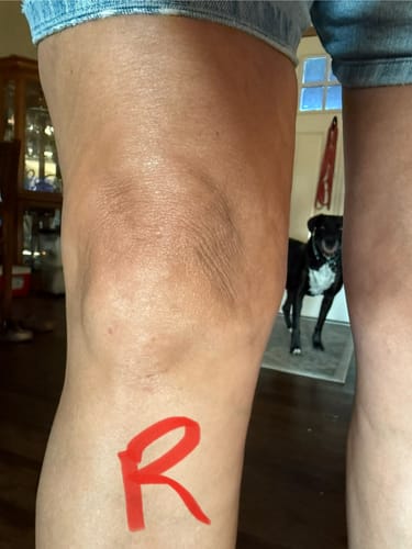 Customer photo review of Dernox Handheld Red Light Wellness Device