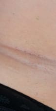 Customer photo review of Smoothskin IPL Pure Fit V2