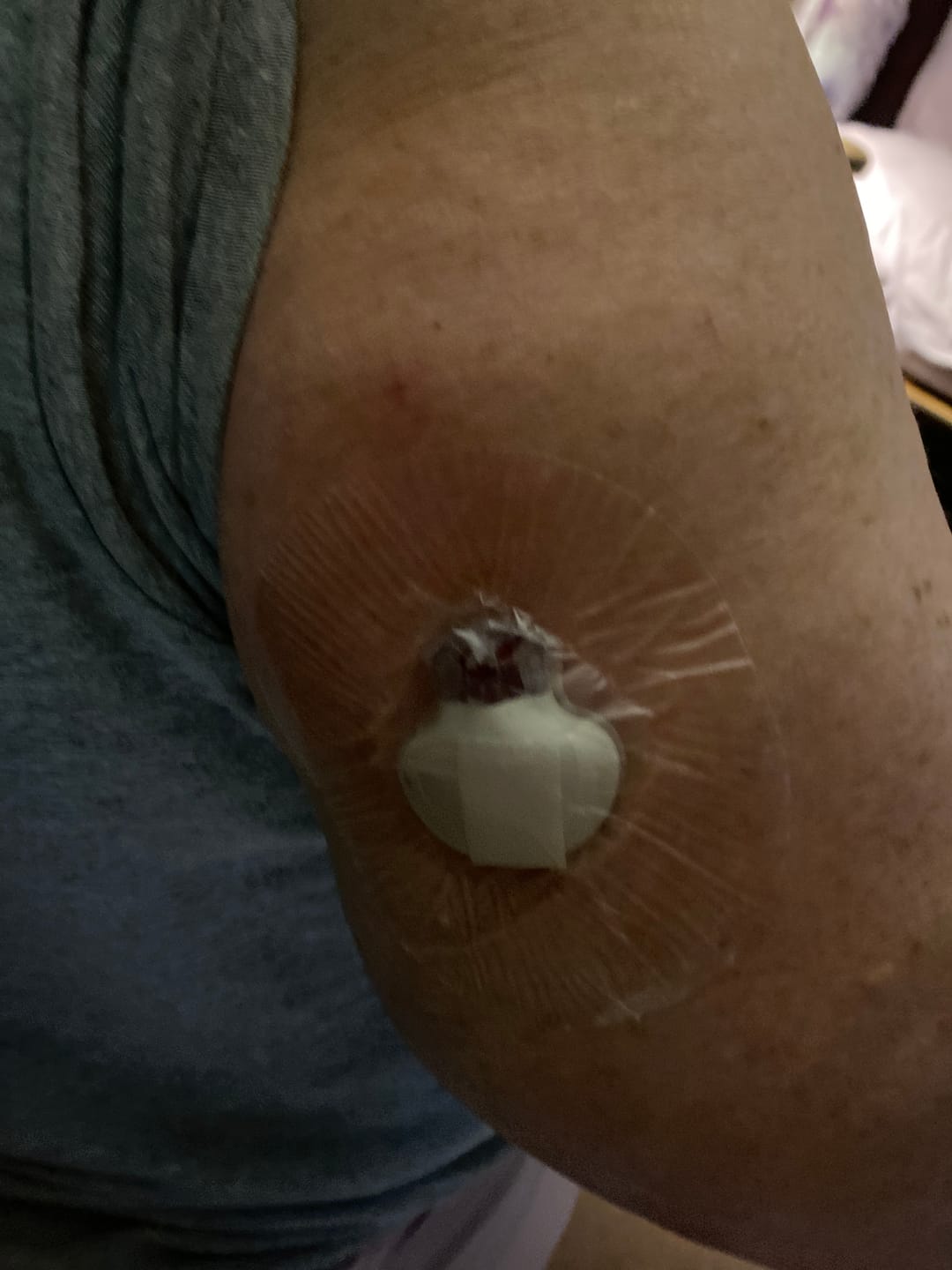 Customer photo review of Skin Grip Original - Medtronic Guardian/Enlite Adhesive Patches