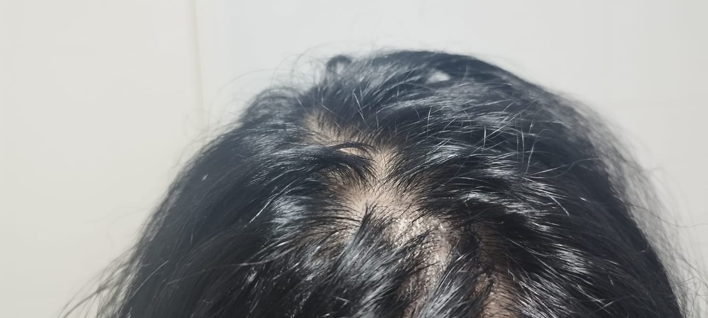 Customer photo review of 3 MESES de DÚO ANTIcaída CRECIMIENTO INTENSIVO Bomba + Tónico ENVÍO GRATIS