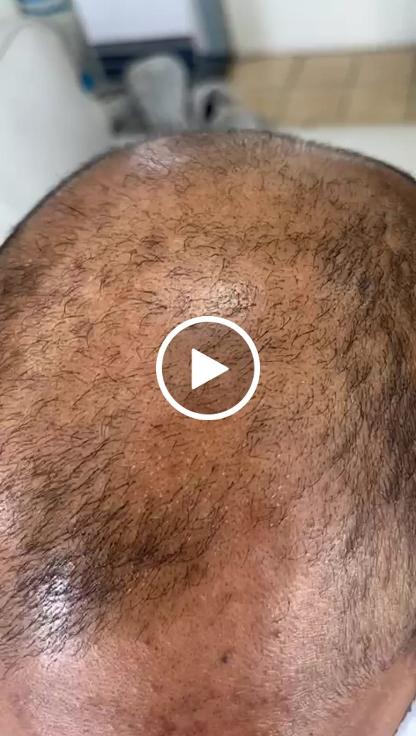 Customer video review of Oilty - Hair Growth Oil