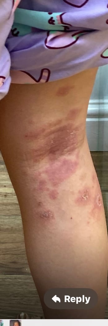 Customer photo review of Bioskin Junior Daily Nourishing Spray