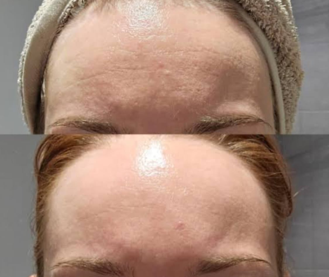 Customer photo review of Encapsulated Retinol 1% Serum 20ml