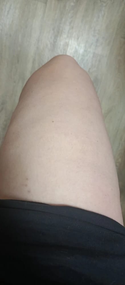 Customer photo review of Revimus Anti-Cellulite Massager