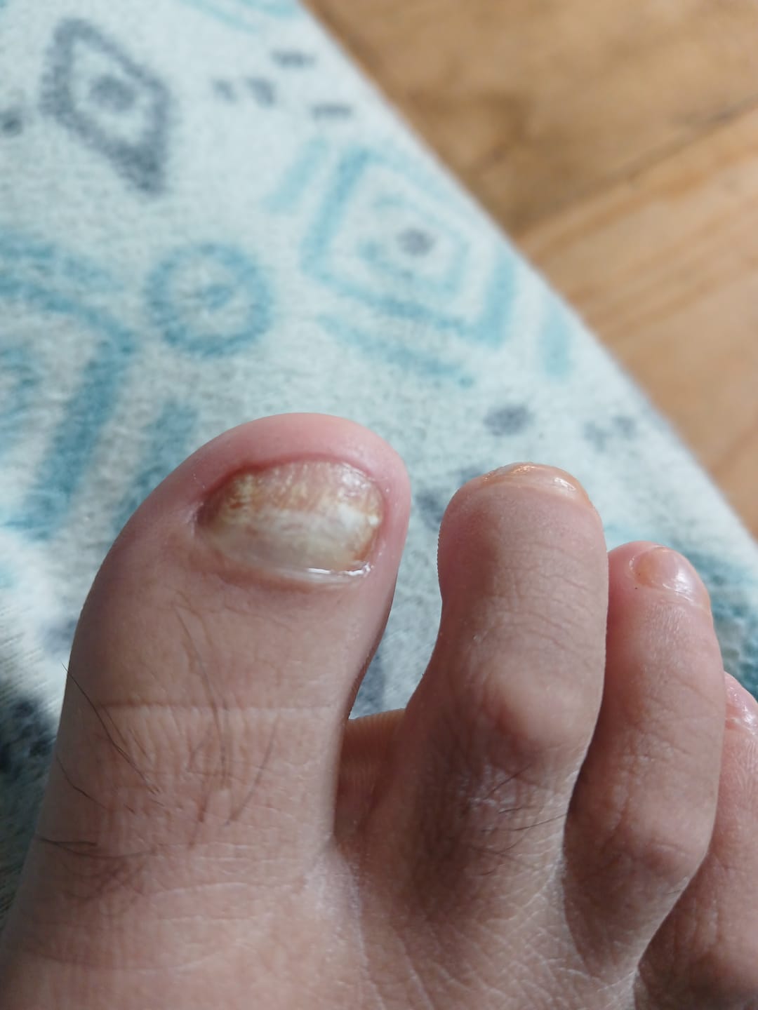Customer photo review of Gotas ByeBye Hongos – Uñas Sanas & Fuertes