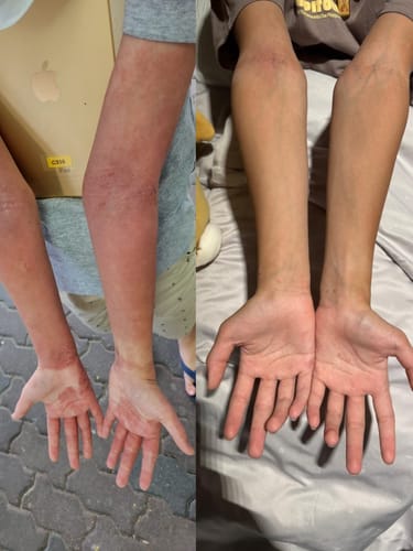 Customer photo review of Eczema Scratch Mitten