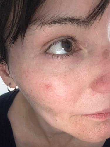 Customer photo review of Micro Infusion Patches