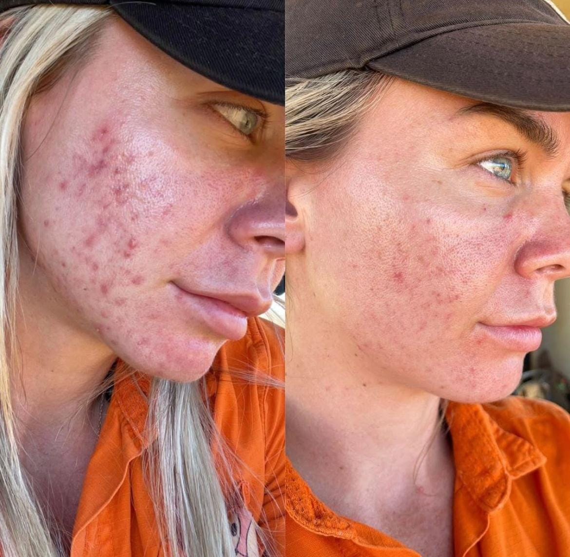 Customer photo review of Acne Set