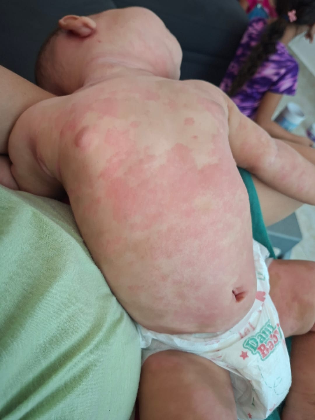 Customer photo review of Scrachee's Flare Up Relief Bundle
