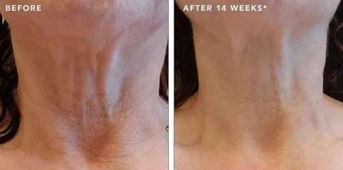 Customer photo review of Masque Haute Performance LED