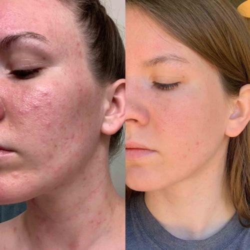 Customer photo review of Masque Haute Performance LED