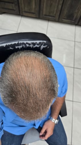 Customer photo review of Novaxidil Triple Therapy Hair Regrowth Foam