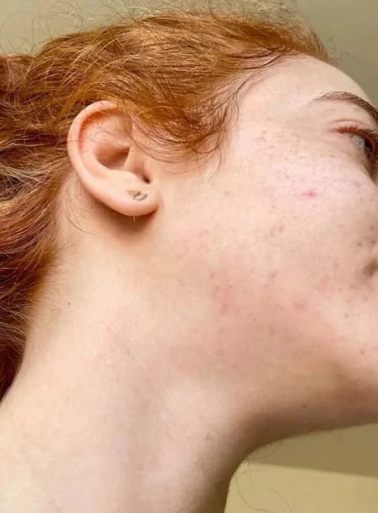Customer photo review of Young Skin Acne Set