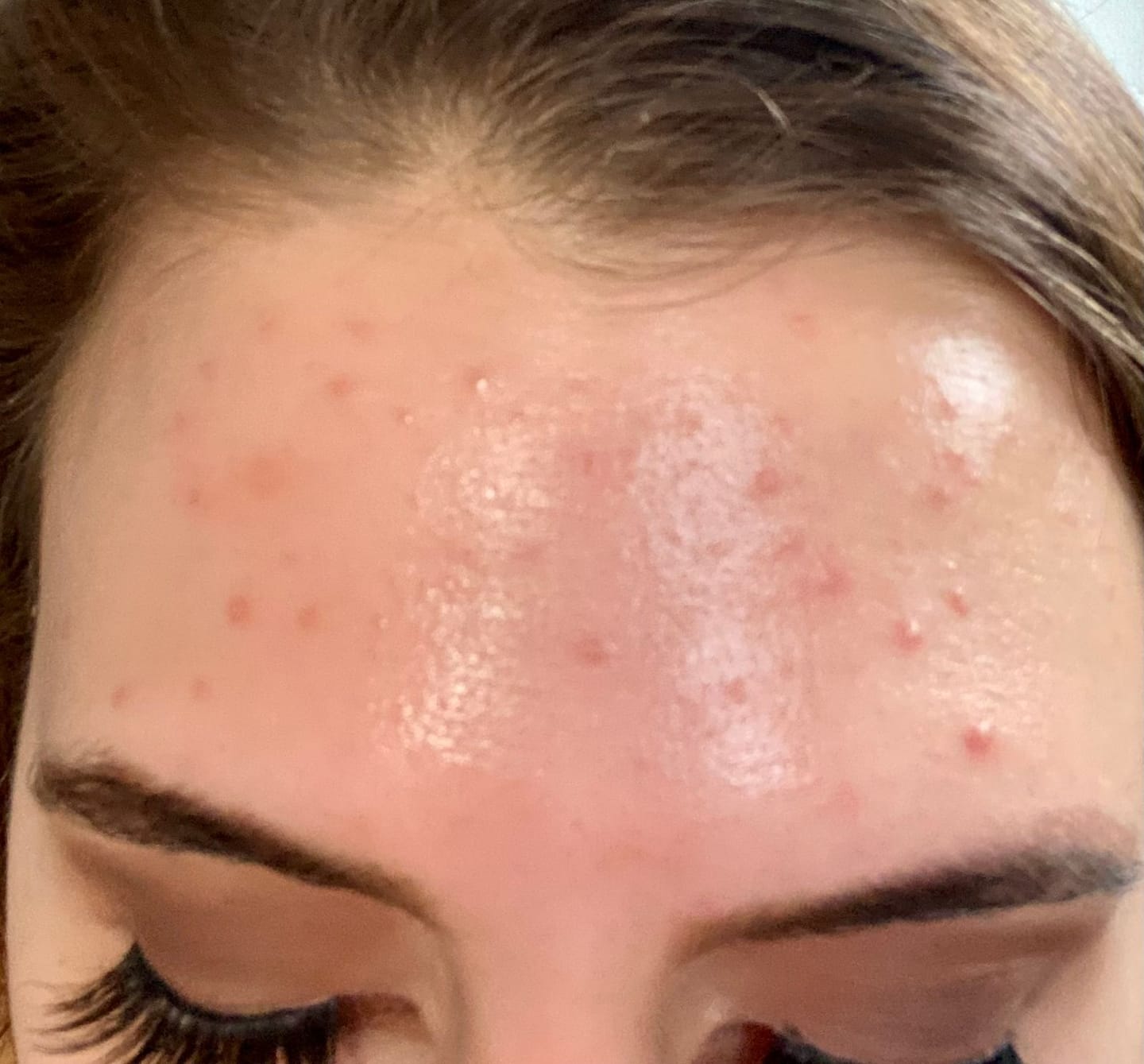 Customer photo review of Acne Formula