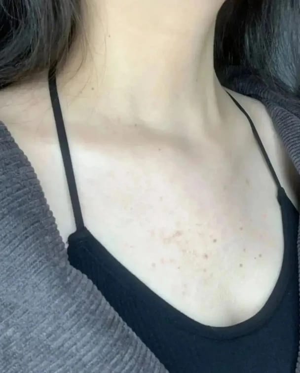 Customer photo review of Acne Set