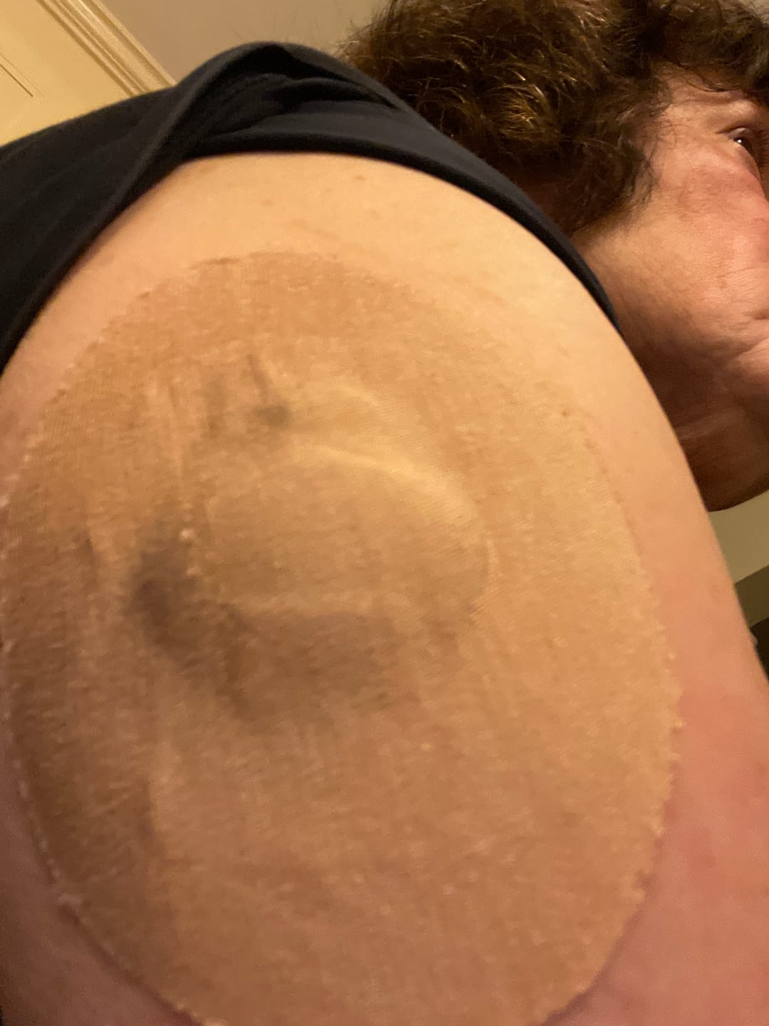 Customer photo review of Skin Grip Original - Medtronic Guardian/Enlite Adhesive Patches