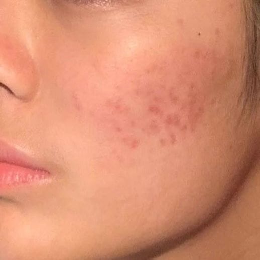 Customer photo review of Acne Formula