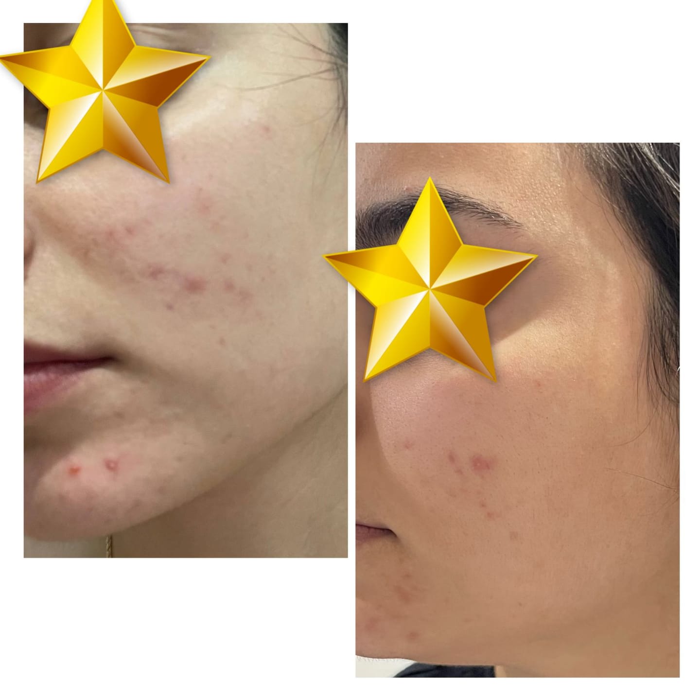 Customer photo review of Acne Formula