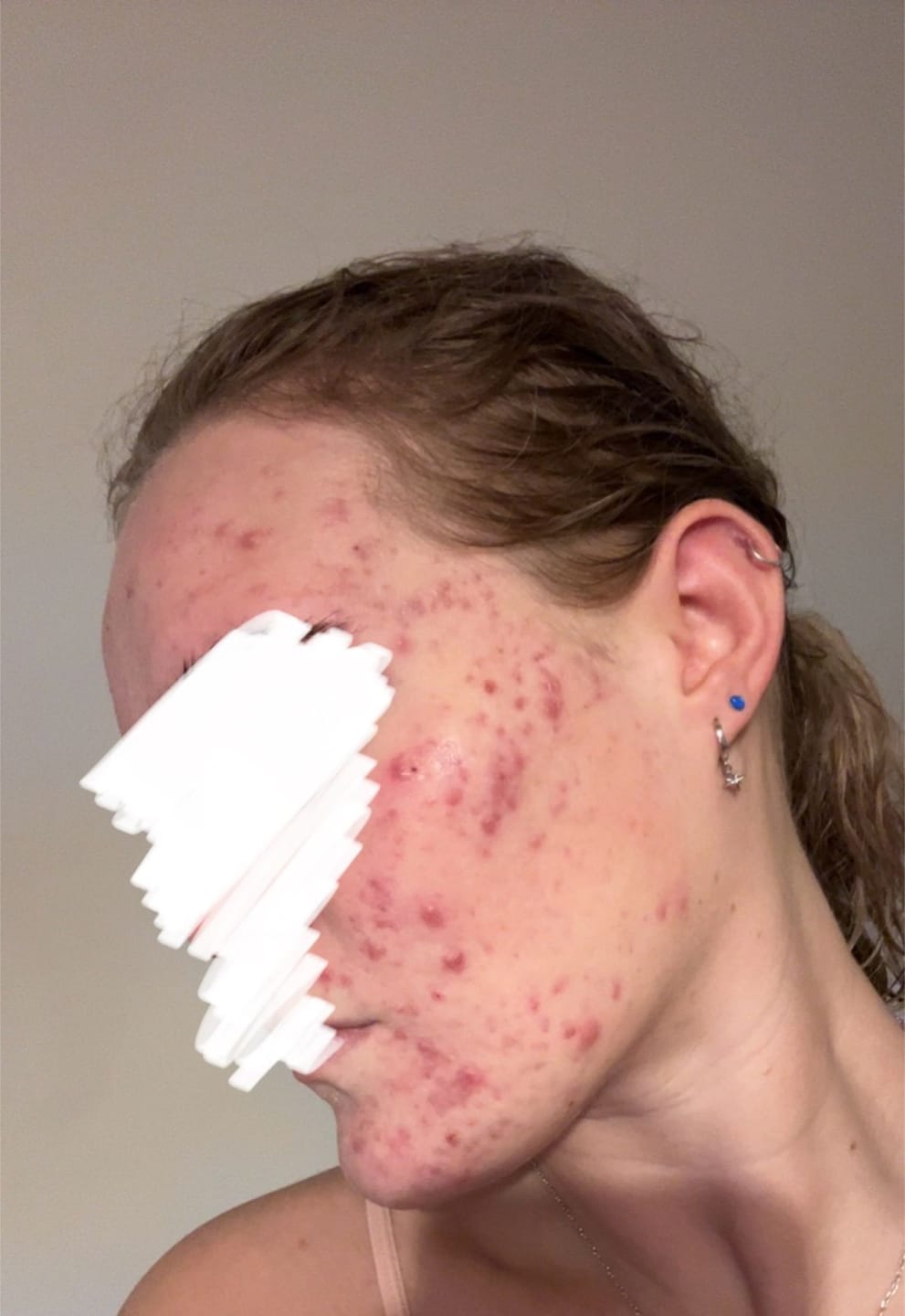 Customer photo review of Acne Formula