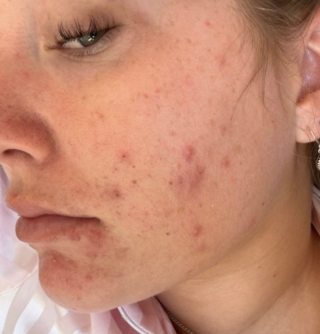 Customer photo review of Acne Formula