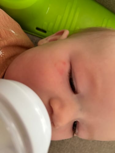 Customer photo review of All Over Ointment Eczema Treatment