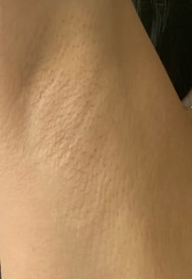 Customer photo review of Smoothskin IPL Pure Fit V2