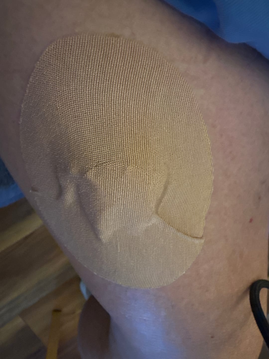 Customer photo review of Skin Grip Original - Medtronic Guardian/Enlite Adhesive Patches