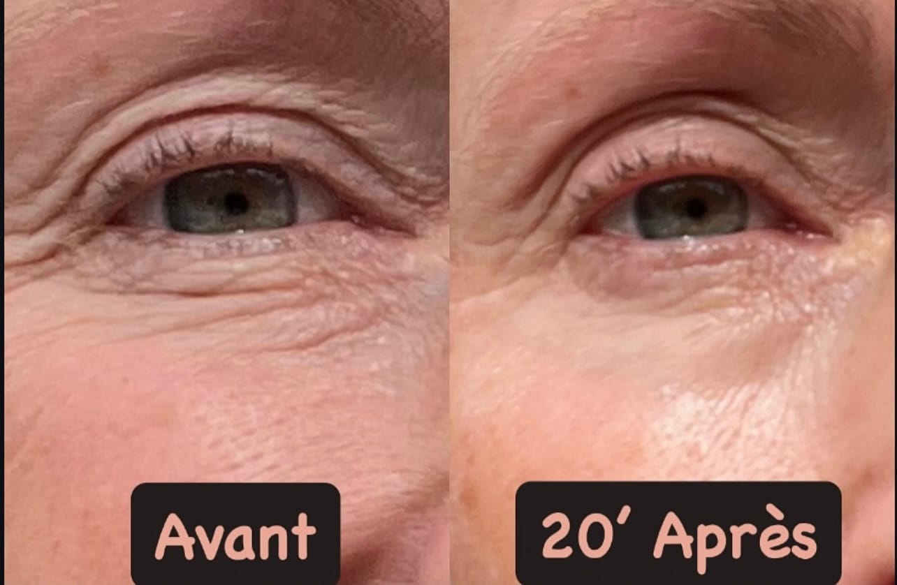 Customer photo review of Ecume - Patchs anti-cernes