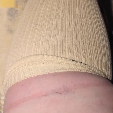 Customer photo review of Diasocks Stödstrumpor