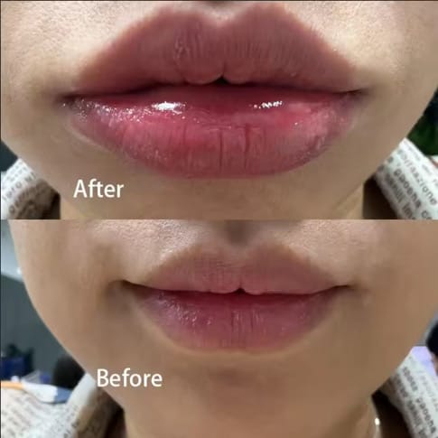 Customer photo review of Plumping Lip filler