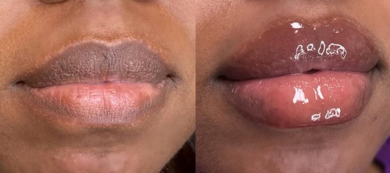 Customer photo review of Plumping Lip filler