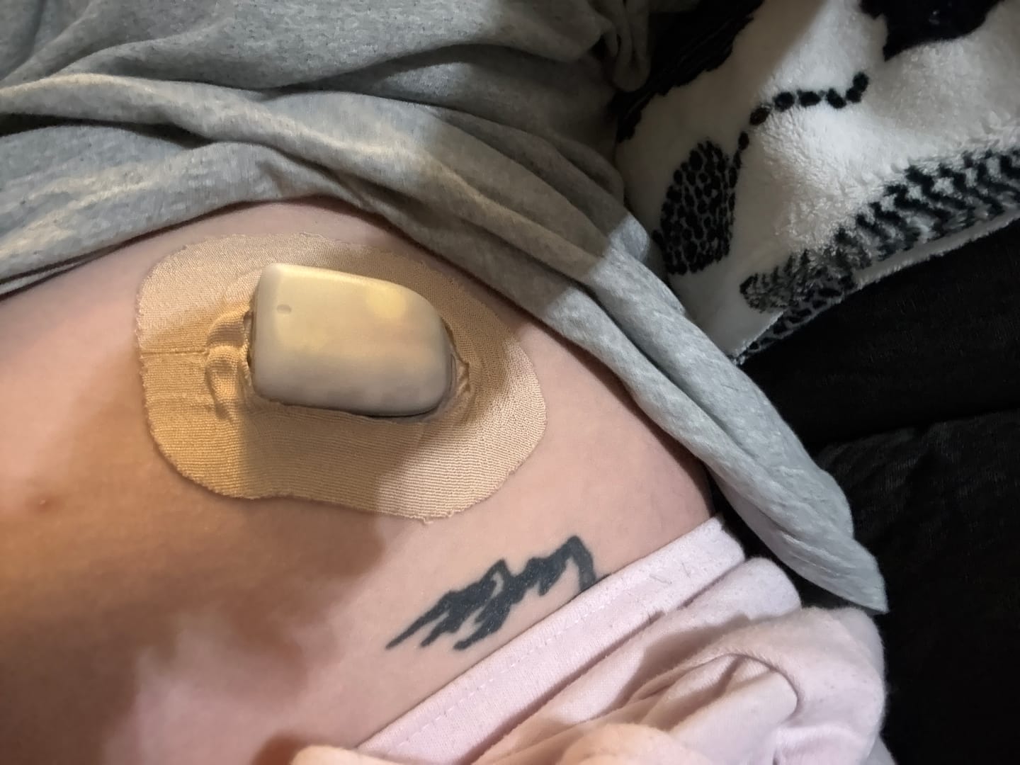 Customer photo review of Skin Grip Original - Omnipod Adhesive Patches