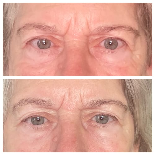 Customer photo review of Kollagen Augen Patches