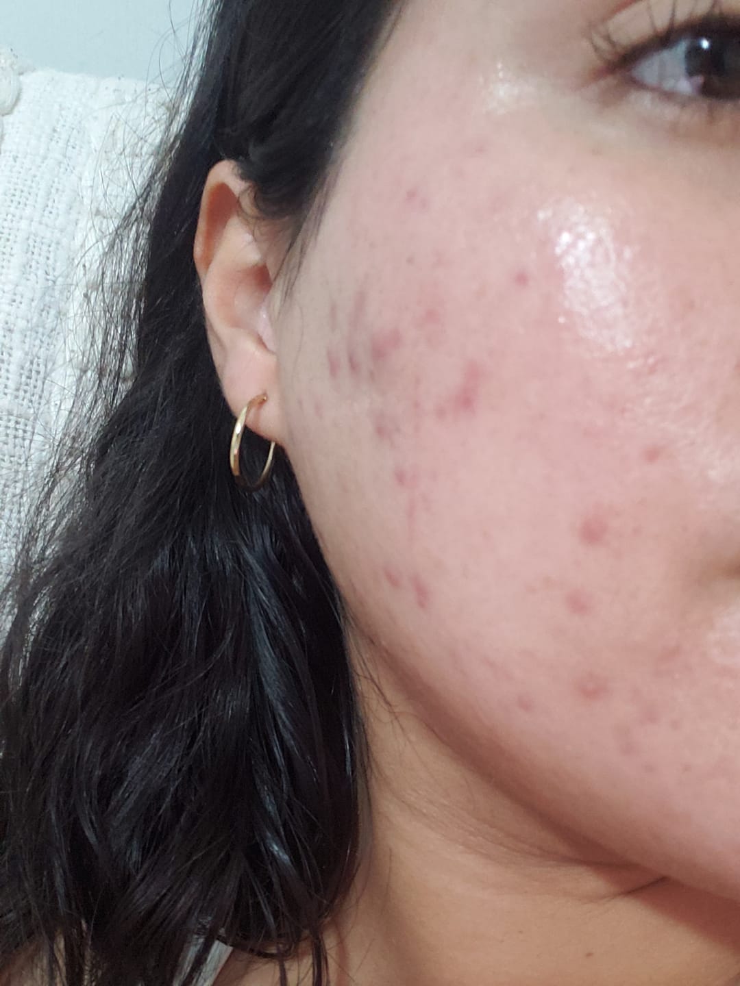 Customer photo review of ANUA - Niacinamide 10% + TXA 4% Serum 30 ML | Suero Antimanchas