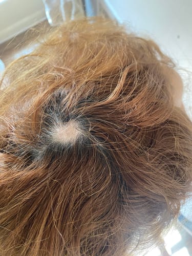 Customer photo review of Glov Hair Regrowth System