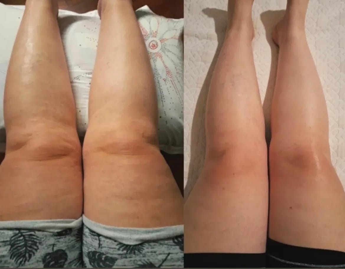 Customer photo review of Bottes de Pressothérapie Novaa® Pro - Massage à compression d'air
