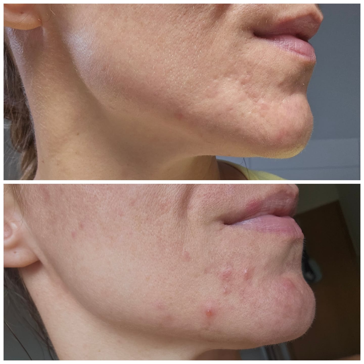 Customer photo review of Porenfeines 4% BHA PEELING